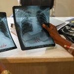 TB reclaims title of deadliest infectious disease. That's an 'outrage' says WHO